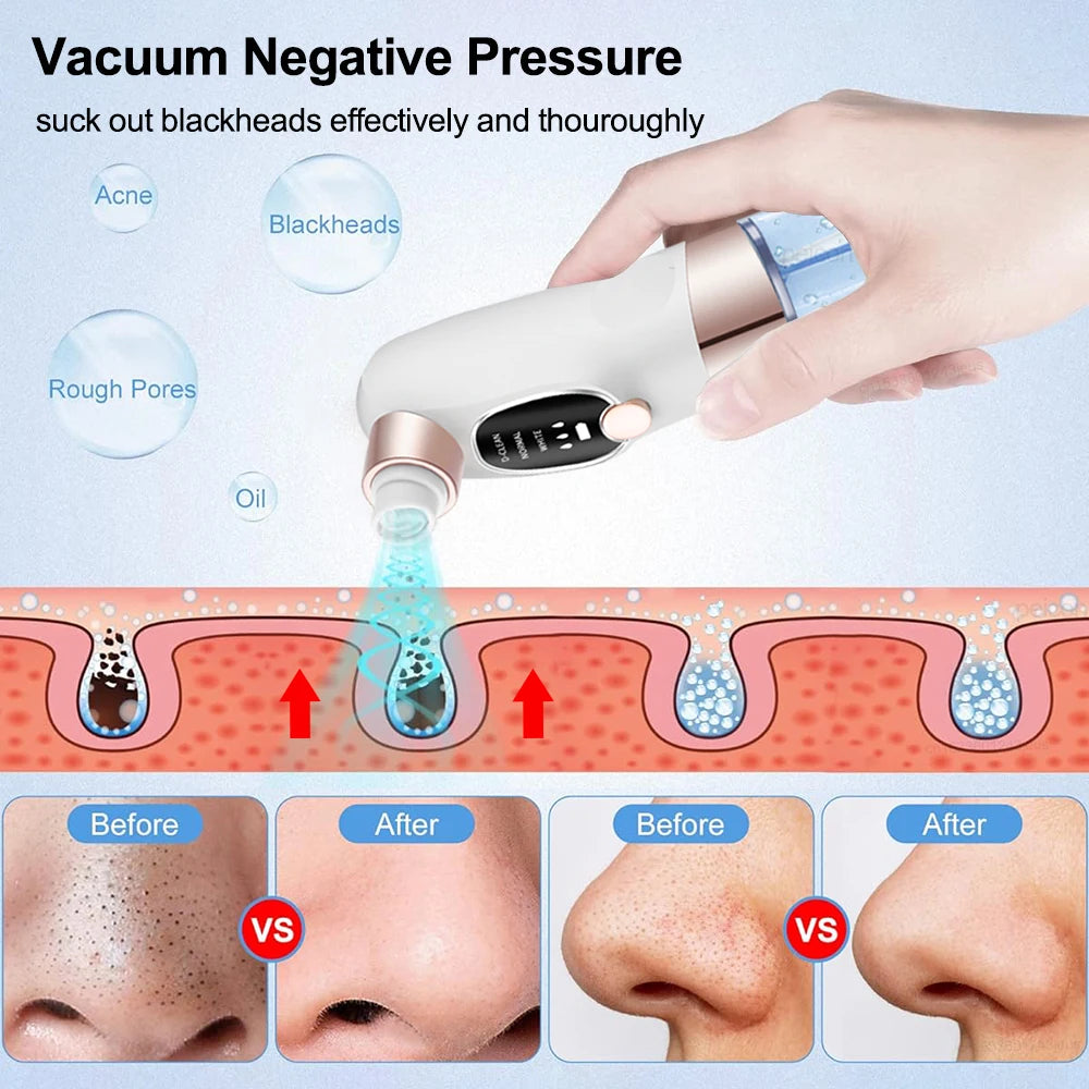 Pore Vacuum Blackhead Remover – Deep Clean & Clear Skin Instantly