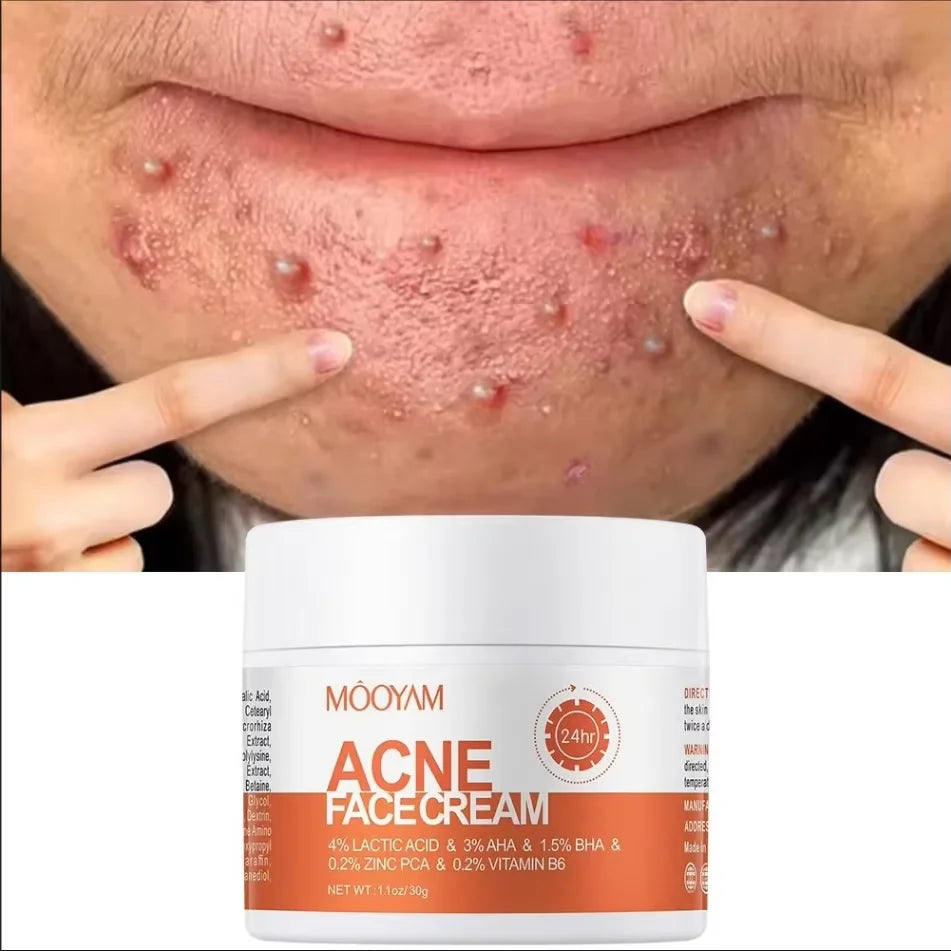 Acne Clear Cream – Smooth Skin Fast